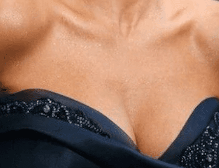 BREAST  IMPLANTS  – HYBRID Breast Augmentation  – Lipofilling