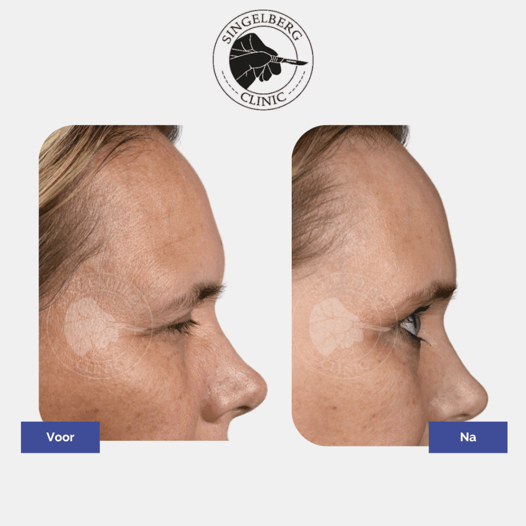 Endoscopic brow lift